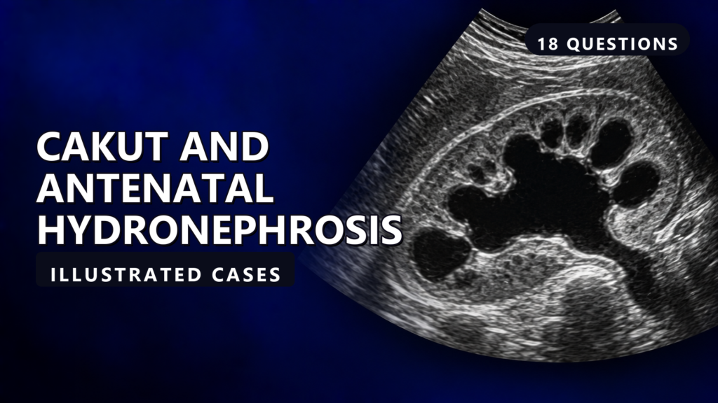 CAKUT and Antenatal Hydronephrosis - illustrated cases thumbnail