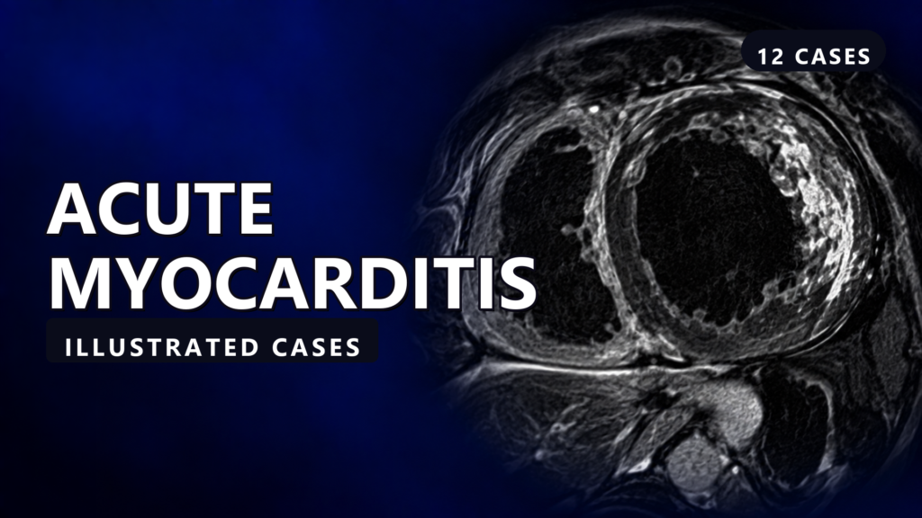 Acute Myocarditis - illustrated cases thumbnail