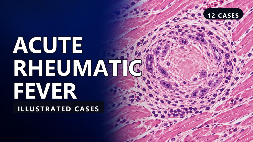 Acute Rheumatic Fever - Illustrated Cases - illustrated cases thumbnail