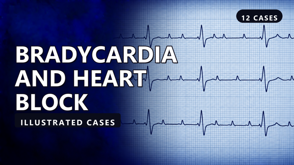 Bradycardia and Heart Block - illustrated cases thumbnail