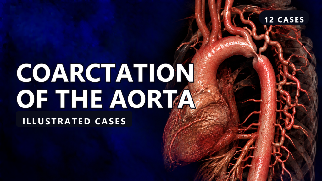 Coarctation of the Aorta - illustrated cases thumbnail