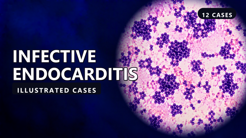 Infective Endocarditis - illustrated cases thumbnail