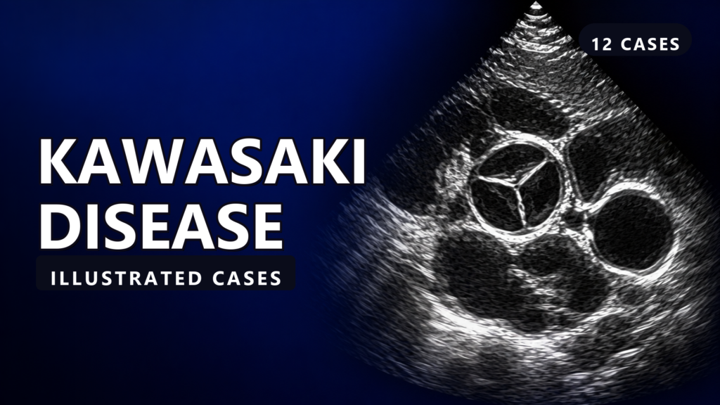 Kawasaki Disease - Illustrated Cases - illustrated cases thumbnail