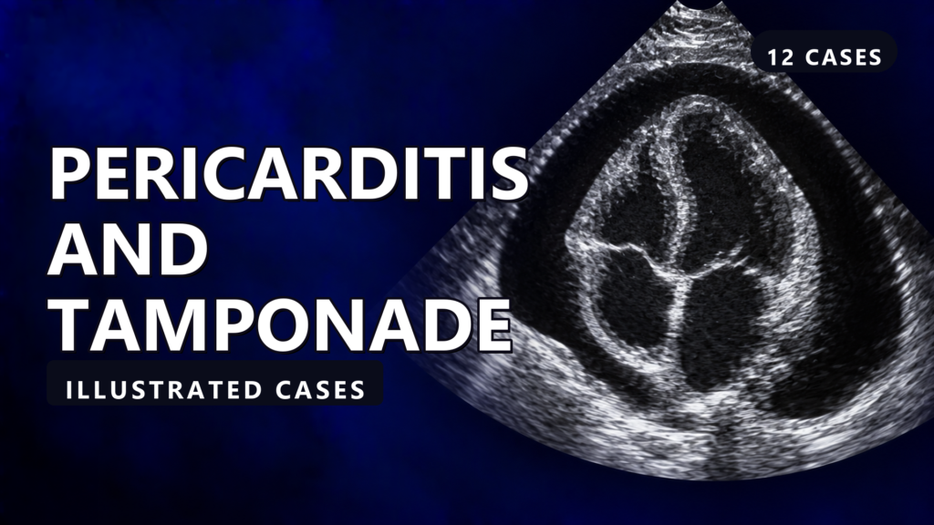 Pericarditis and Tamponade - illustrated cases thumbnail