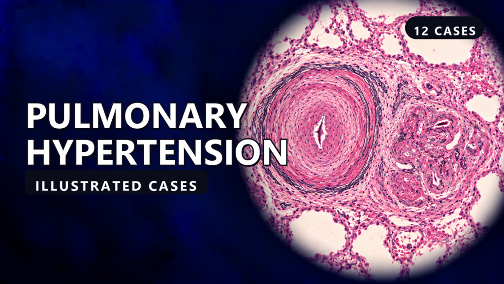 Pulmonary Hypertension - illustrated cases thumbnail