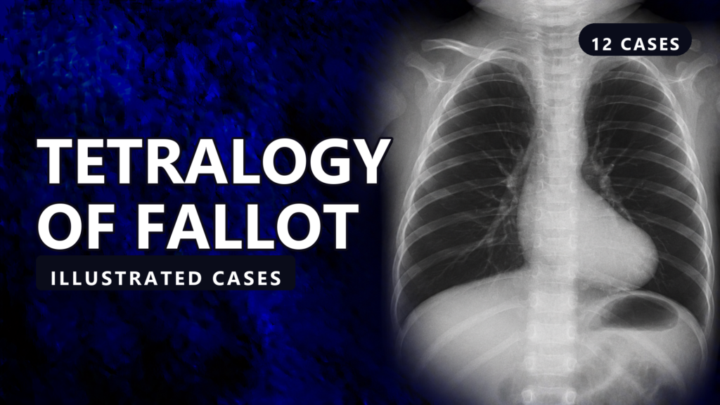 Tetralogy of Fallot - illustrated cases thumbnail