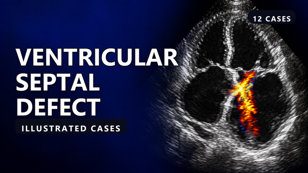 Ventricular Septal Defect - illustrated cases thumbnail