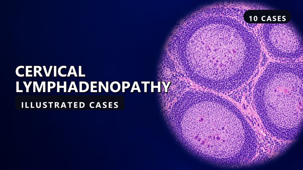 Cervical Lymphadenopathy - illustrated cases thumbnail