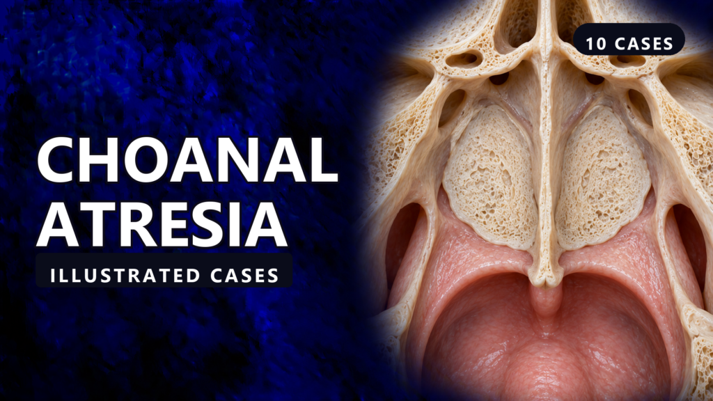 Choanal Atresia - illustrated cases thumbnail