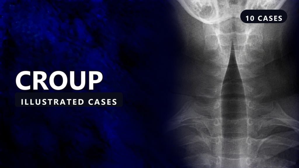 Croup - illustrated cases thumbnail