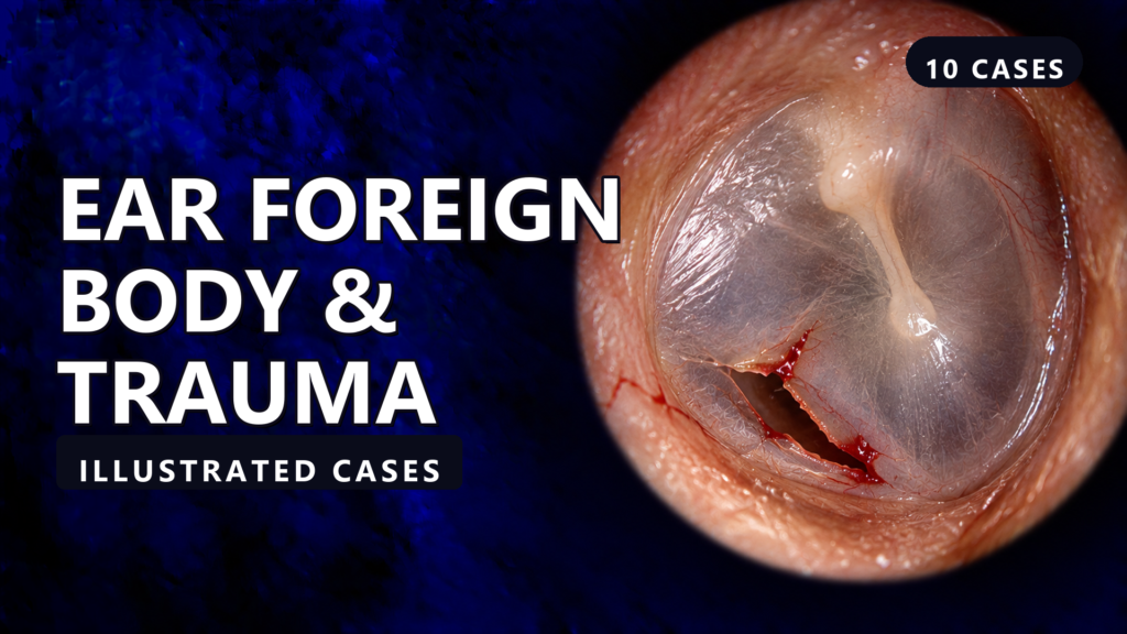 Ear Foreign Body & Trauma - illustrated cases thumbnail
