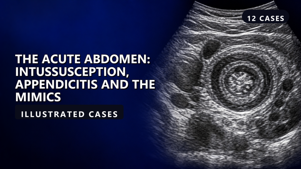 The Acute Abdomen: Intussusception, Appendicitis and the Mimics - illustrated cases thumbnail