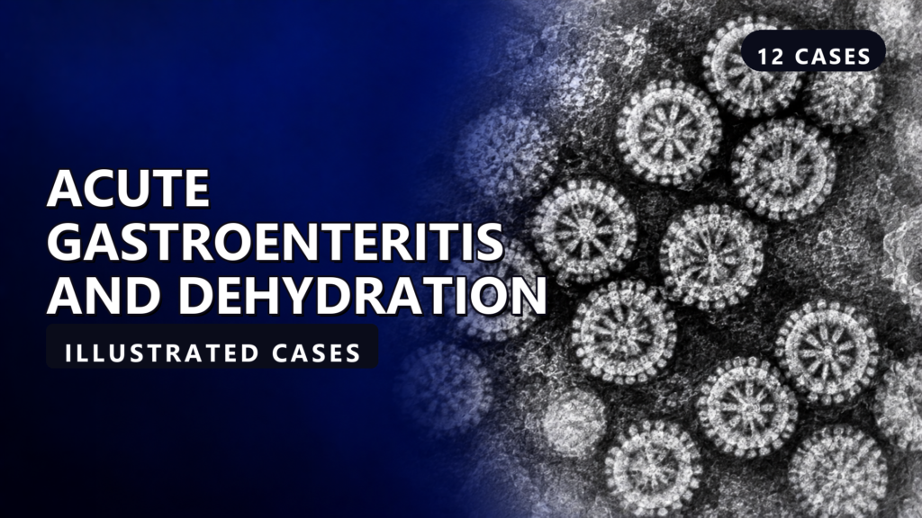 Acute Gastroenteritis and Dehydration - illustrated cases thumbnail