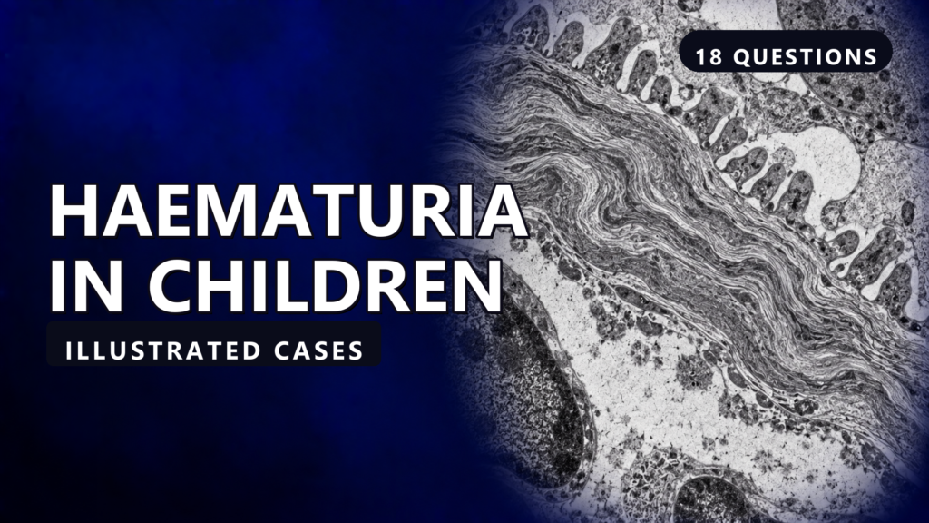 Haematuria in Children - illustrated cases thumbnail