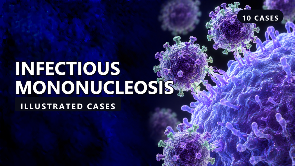 Infectious Mononucleosis - illustrated cases thumbnail