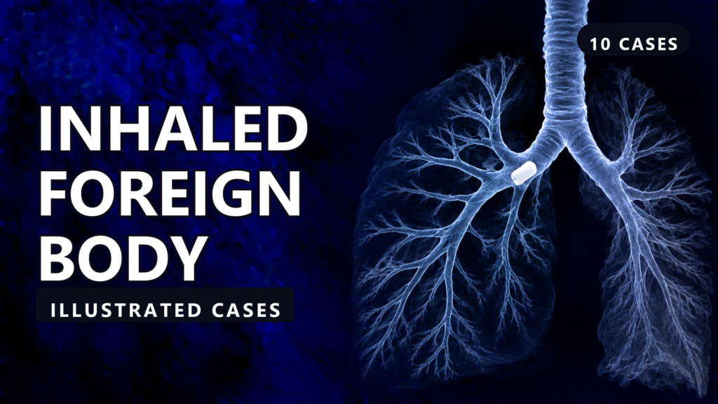 Inhaled Foreign Body - illustrated cases thumbnail