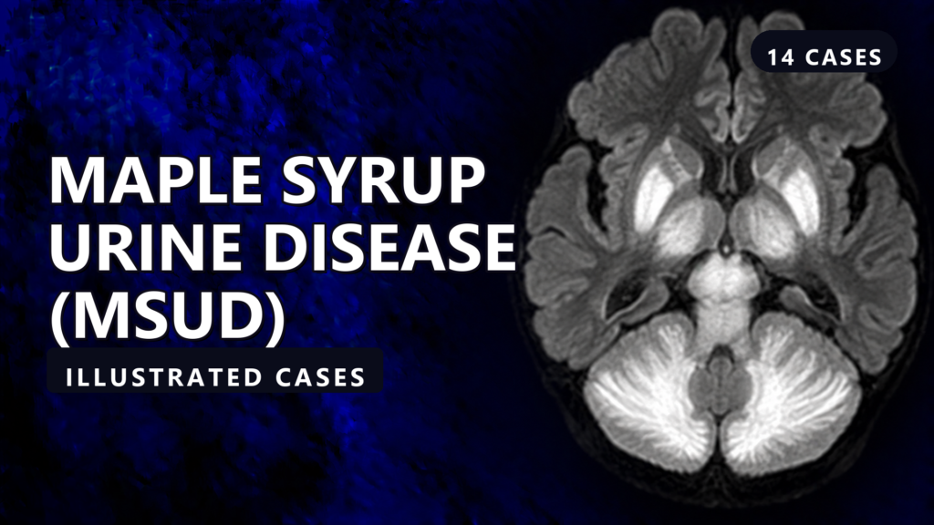 Maple Syrup Urine Disease (MSUD) - illustrated cases thumbnail