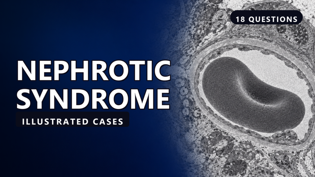 Nephrotic Syndrome - illustrated cases thumbnail