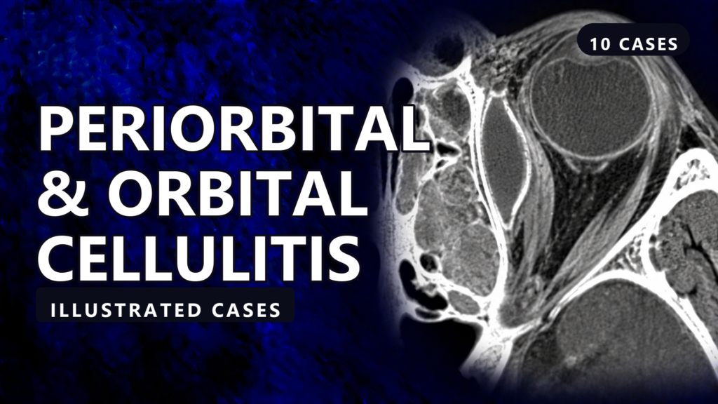 Periorbital & Orbital Cellulitis - illustrated cases thumbnail