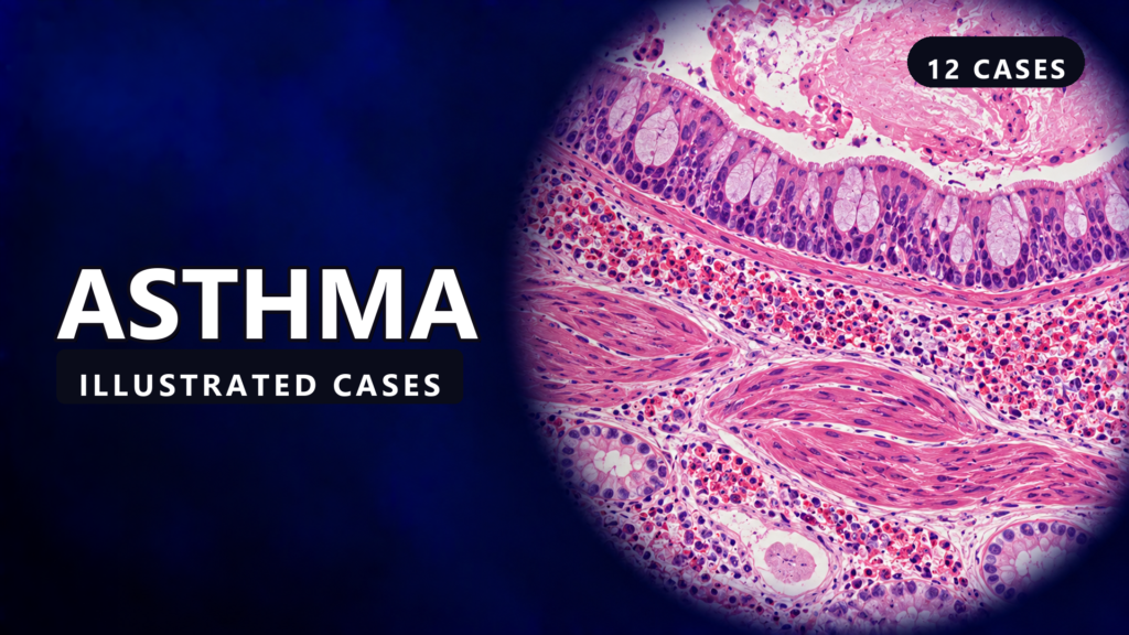 Asthma - illustrated cases thumbnail