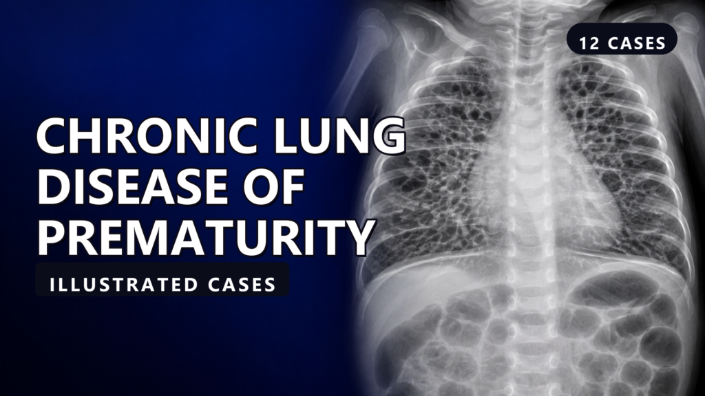 Chronic Lung Disease of Prematurity - Illustrated Cases - illustrated cases thumbnail