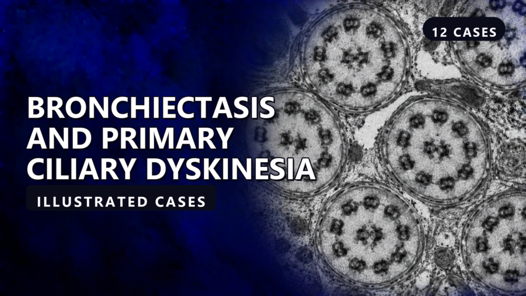 Bronchiectasis and Primary Ciliary Dyskinesia - illustrated cases thumbnail