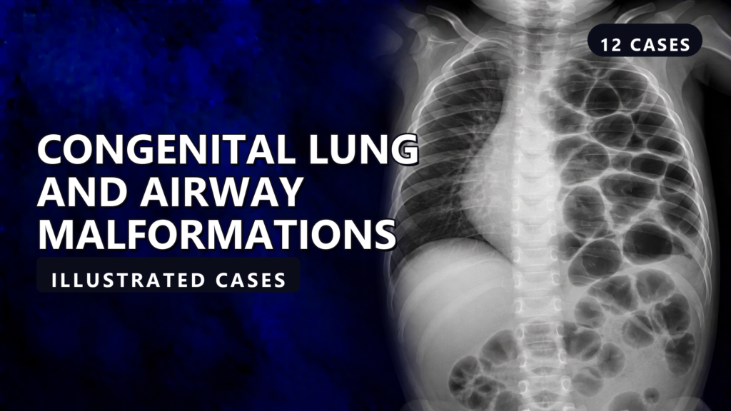 Congenital Lung and Airway Malformations - illustrated cases thumbnail