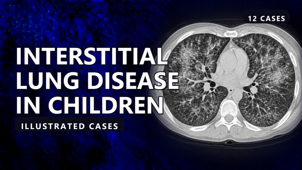 Interstitial Lung Disease in Children - illustrated cases thumbnail