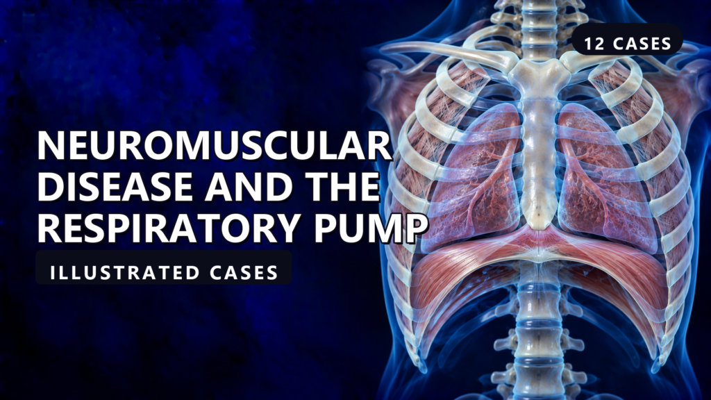 Neuromuscular Disease and the Respiratory Pump - illustrated cases thumbnail