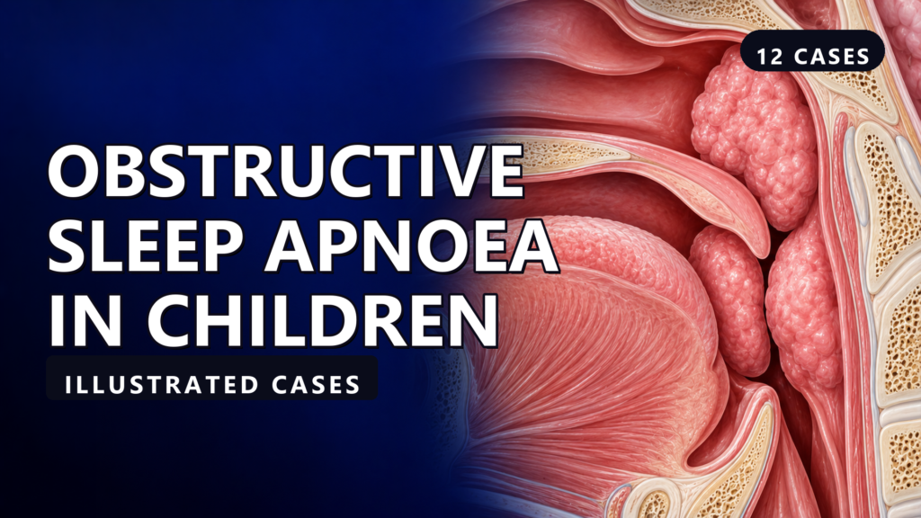 Obstructive Sleep Apnoea in Children - illustrated cases thumbnail