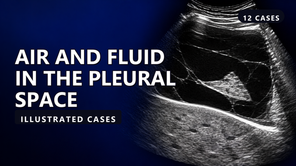 Air and Fluid in the Pleural Space - Illustrated Cases - illustrated cases thumbnail