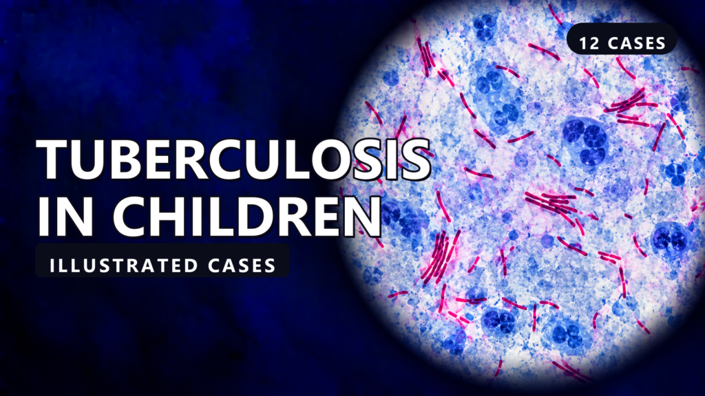 Tuberculosis in Children - illustrated cases thumbnail