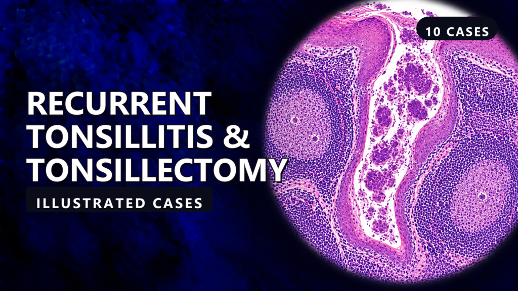 Recurrent Tonsillitis & Tonsillectomy - illustrated cases thumbnail